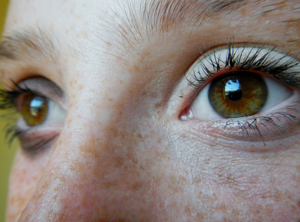 Mengapa Freckles Bisa Muncul pada Kulit?