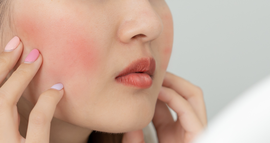 Tidak Semua Kemerahan di Wajah Adalah Jerawat: Kenali Perbedaan Rosacea dan Jerawat