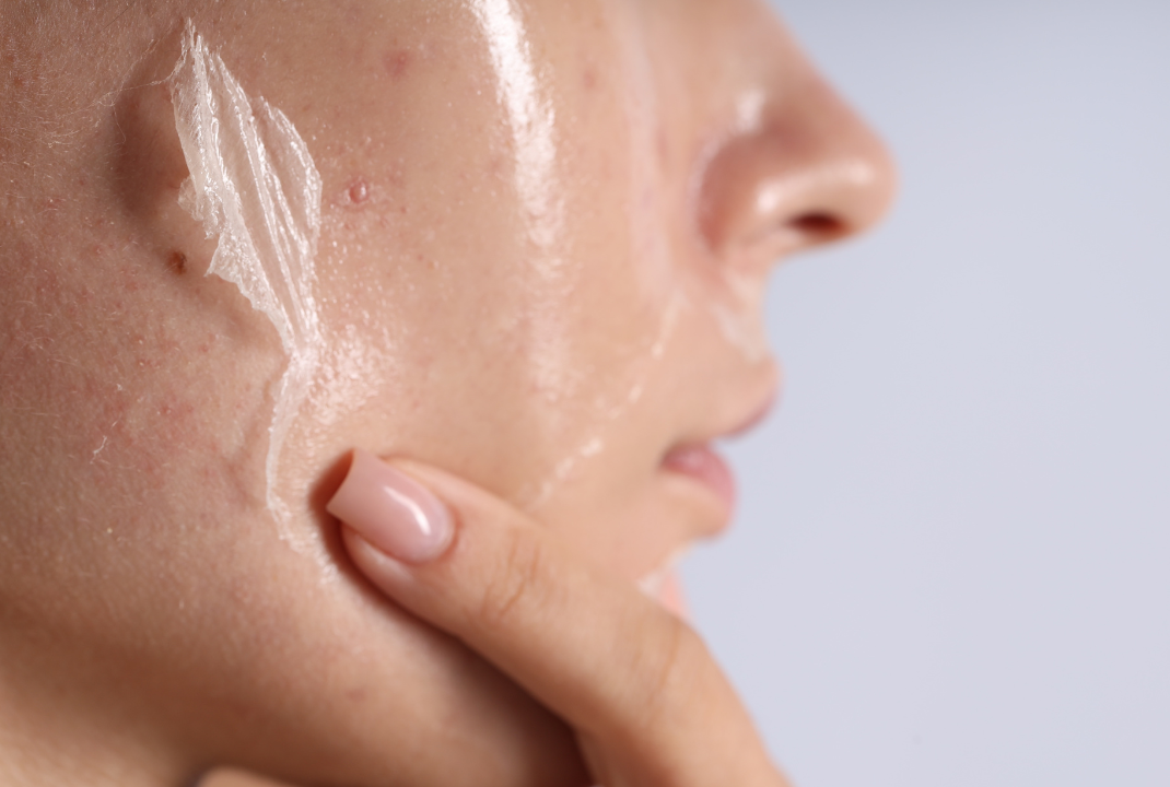 Kulit Mengelupas Setelah Pakai Skincare? Jangan Langsung Panik