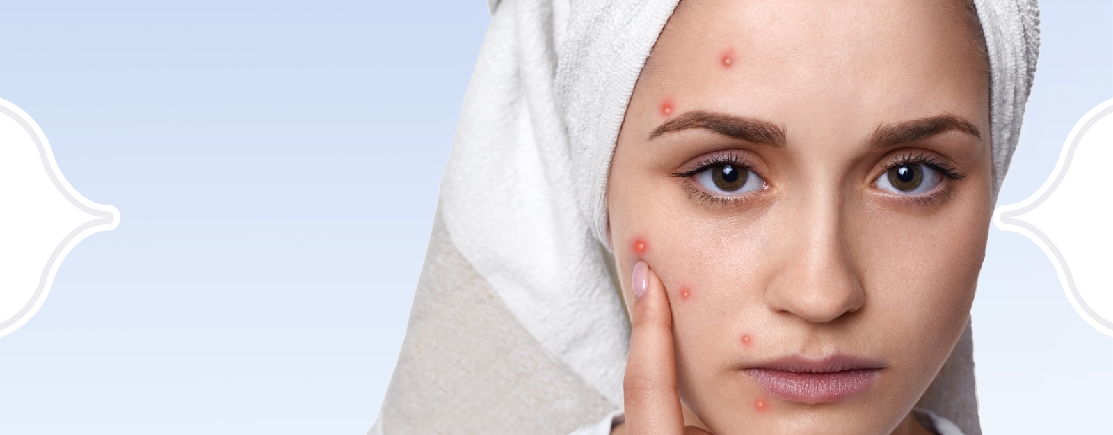 Rekomendasi Serum Terbaik buat Ngilangin Jerawat!